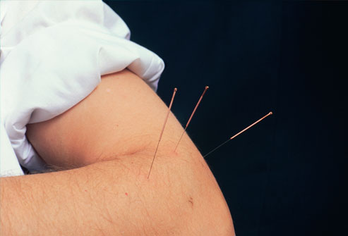 phototake_rm_photo_of_acupuncture_needle